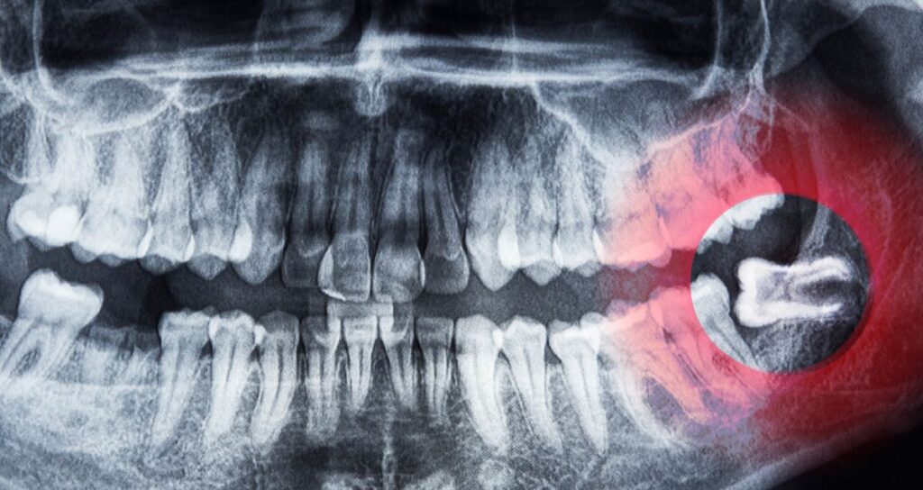Wisdom Teeth