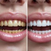 Feature (13) Tooth Whitening