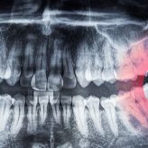 Feature (15) Wisdom Teeth