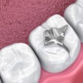fissure-sealants fissure-sealants
